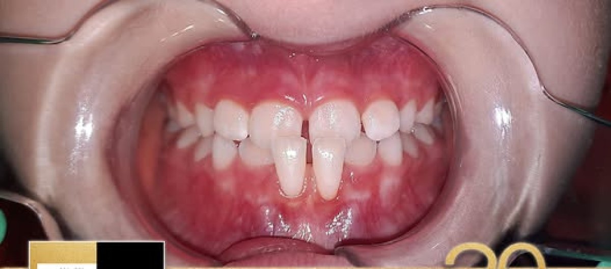 Before braces at dr. Vladau Studio – dental crowding and misalignment visible in patient