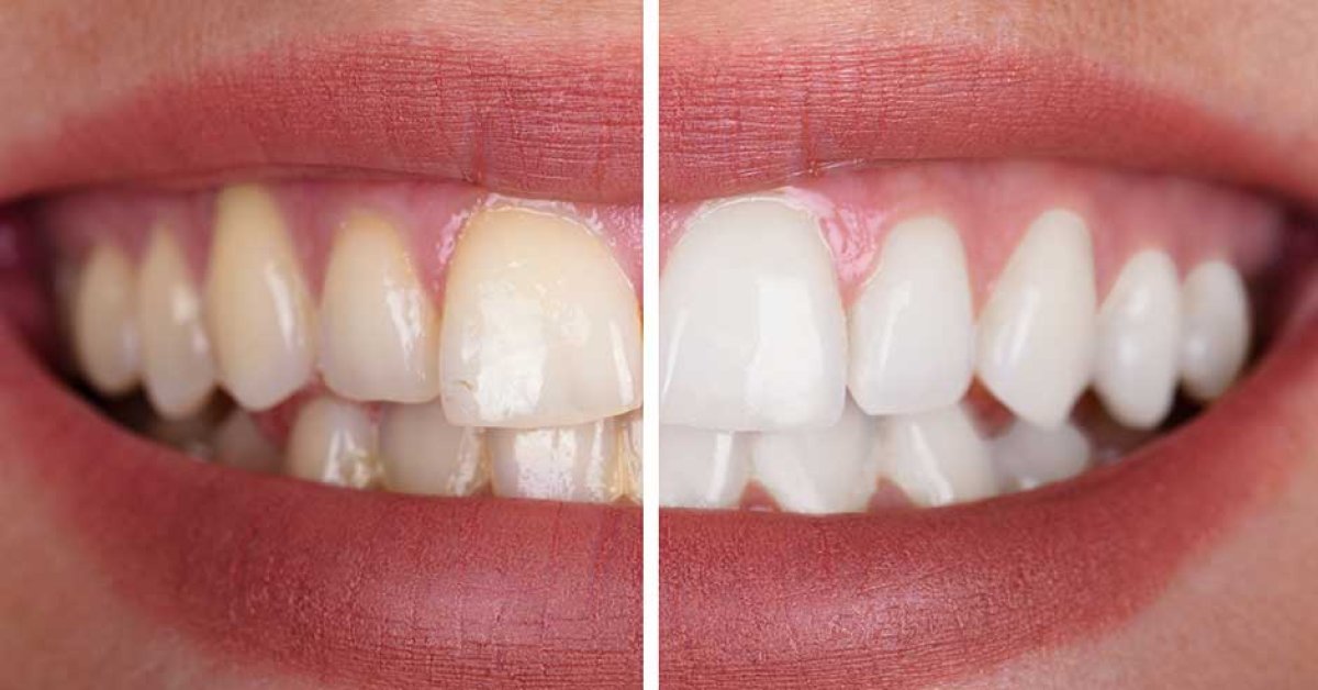 Before and after tooth whitening results at dr. Vladau Studio – visibly brighter smile