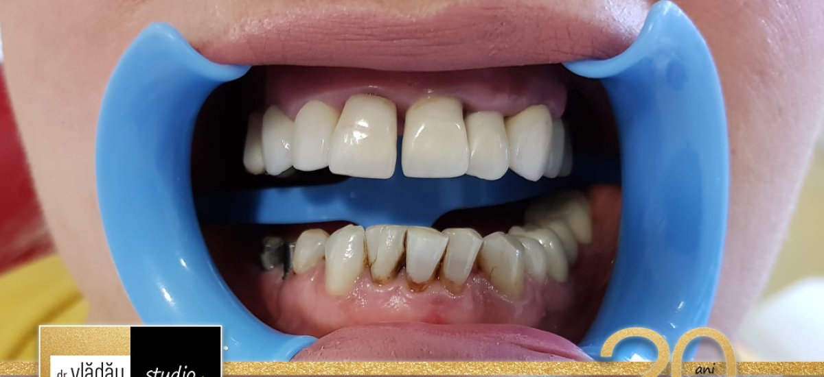 Before and after tooth whitening results at dr. Vladau Studio, visible brighter smile transformation