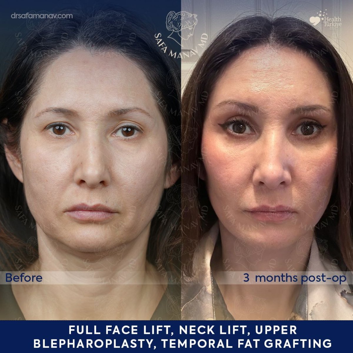 Efekty przed i po deep plane facelift w Dr. Safa Manav Clinic, widoczne odmłodzenie twarzy