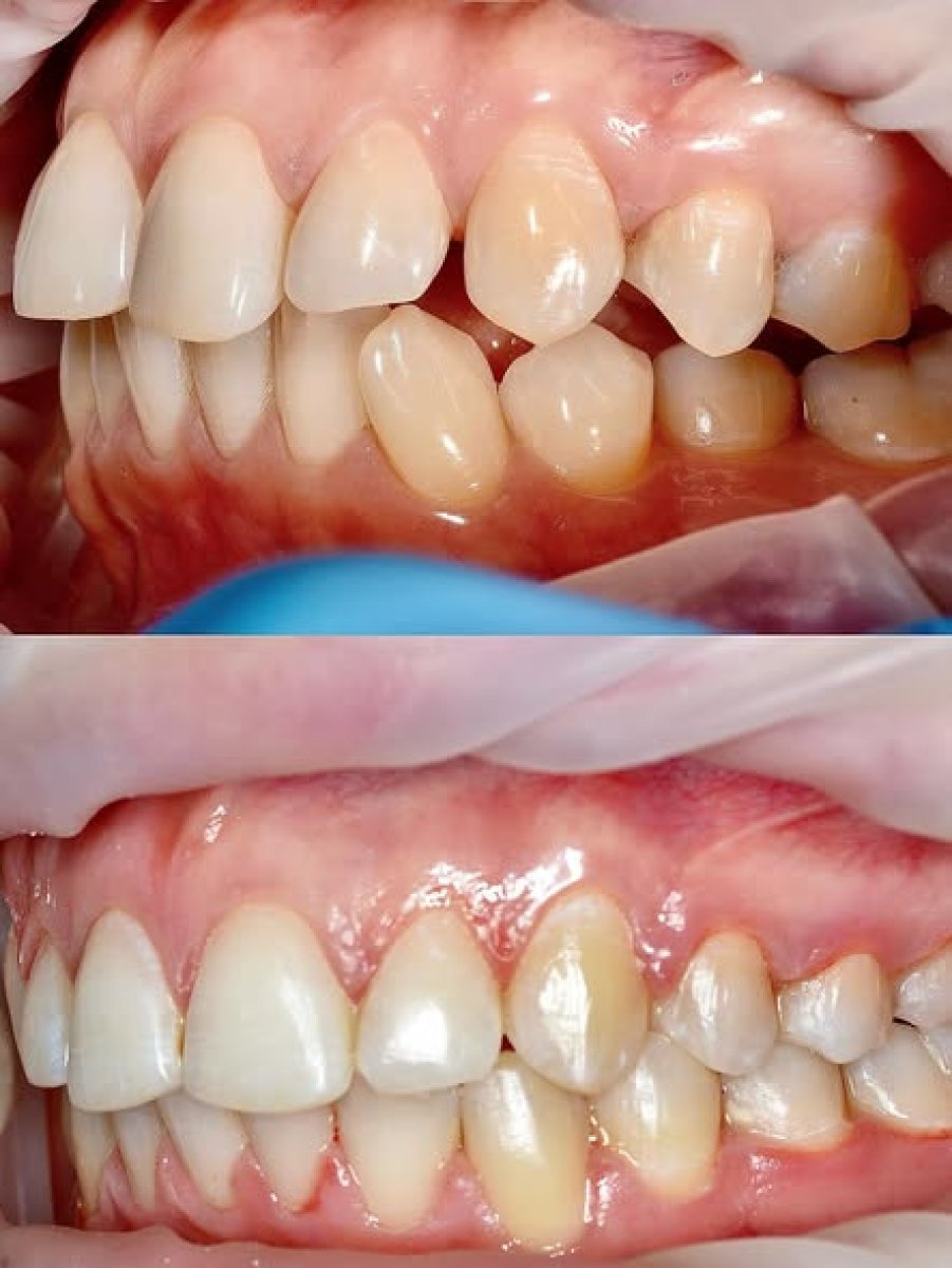 نتائج قبل وبعد تقويم Invisalign في Стоматологічна клініка Axilar، تحسين انتظام الأسنان
