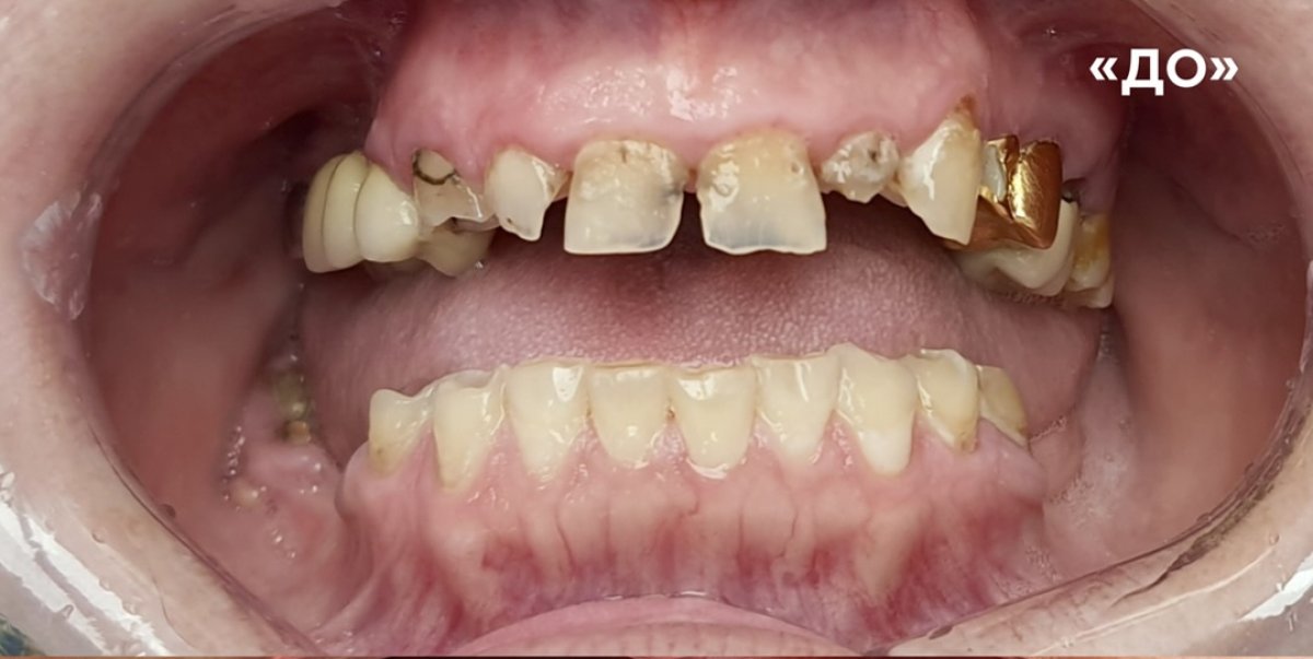 Damaged teeth before dental crown installation at Стоматологічна клініка Axilar