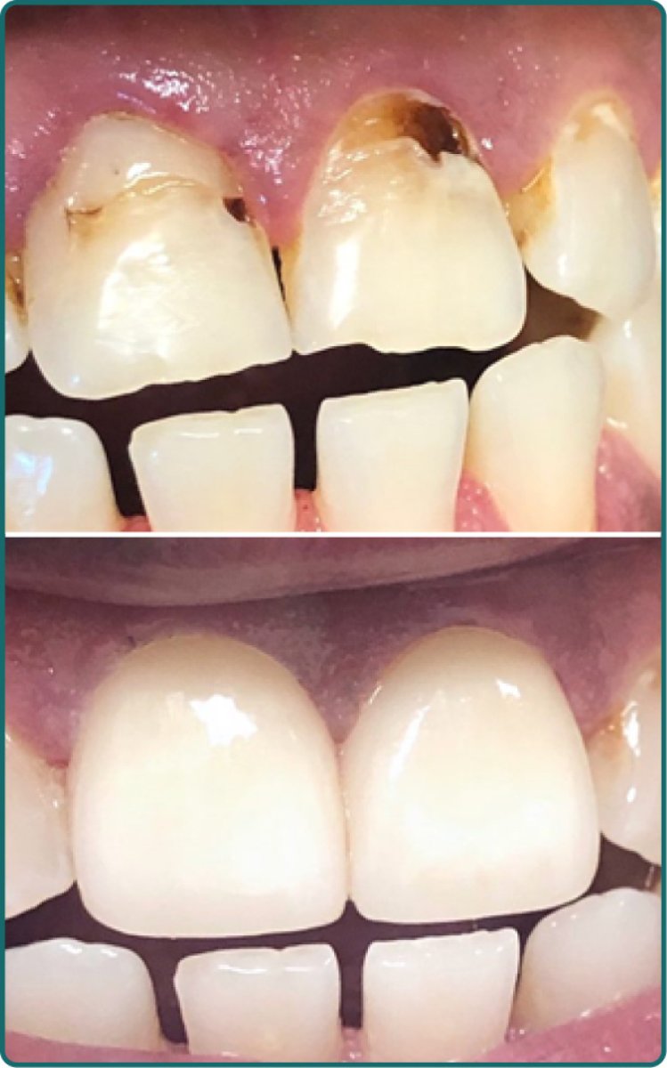 Before and after tooth restoration (bonding) results at Стоматологічна клініка Axilar