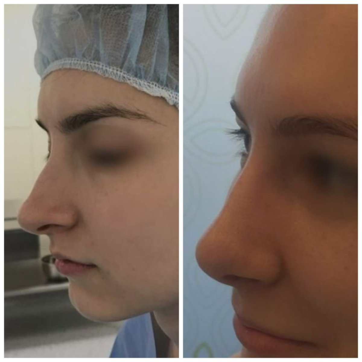 نتيجة عملية تجميل الأنف قبل وبعد في عيادة Radzikowska، تحسين شكل الأنف