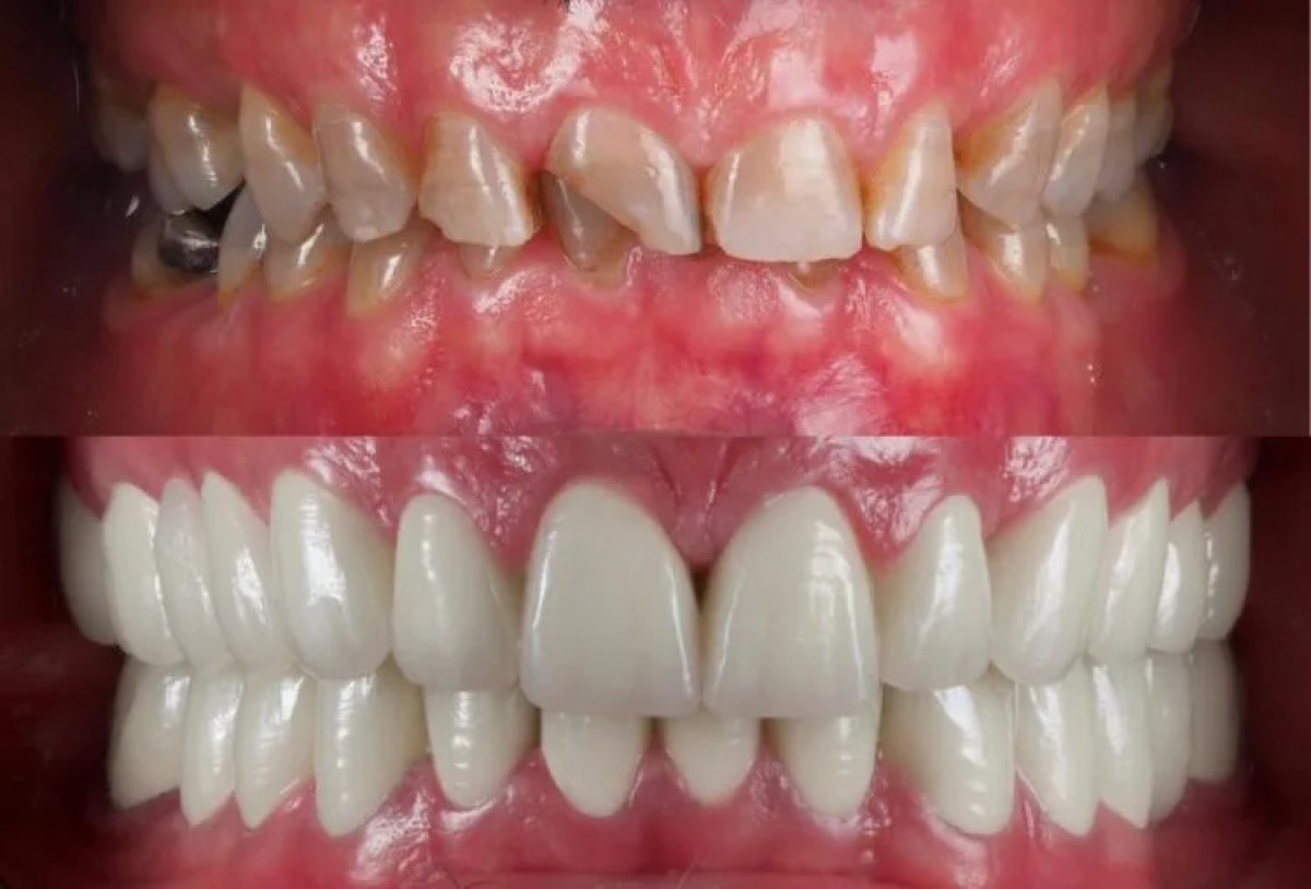 Smile makeover before and after results – dental veneers for improved teeth appearance