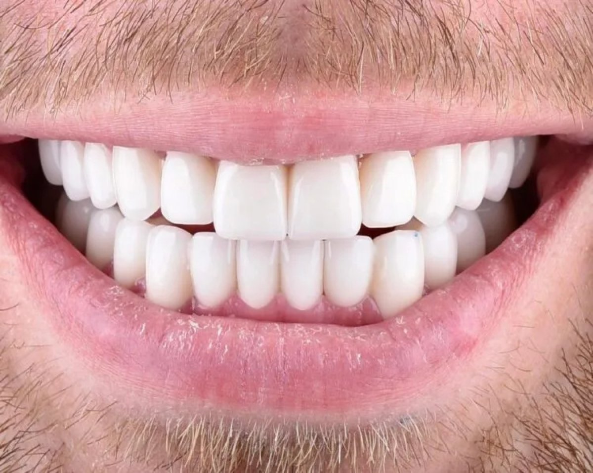 Resultado de blanqueamiento dental láser en clínica: sonrisa más blanca y brillante