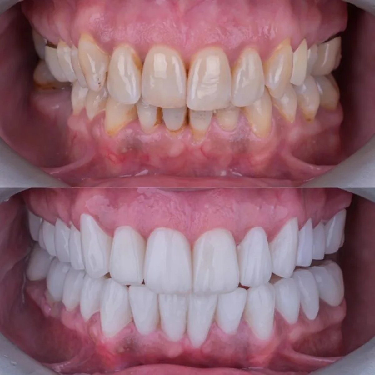 Before and after laser teeth whitening results – visibly brighter smile transformation