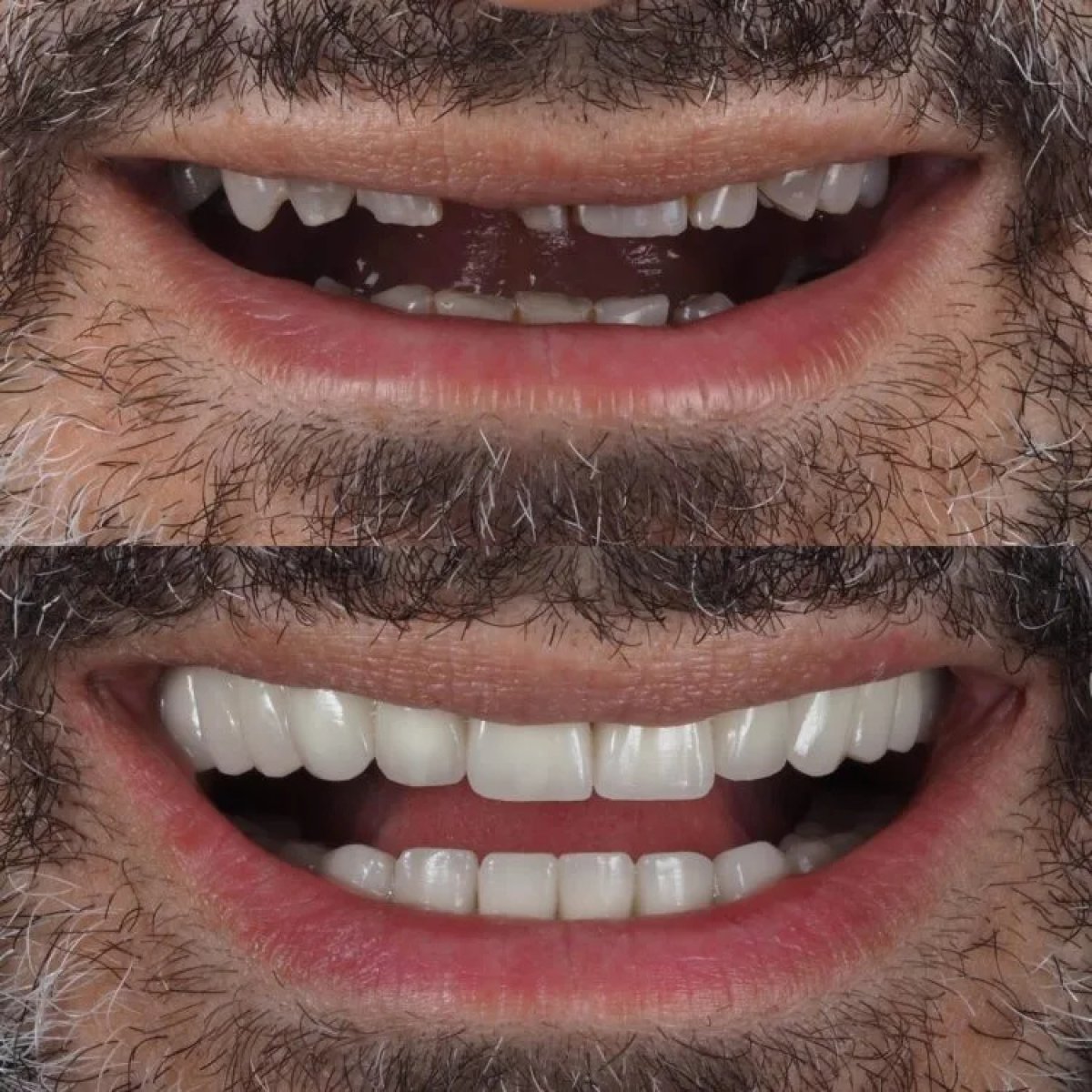 Resultados antes y después de implantes dentales: sonrisa restaurada y dientes completos