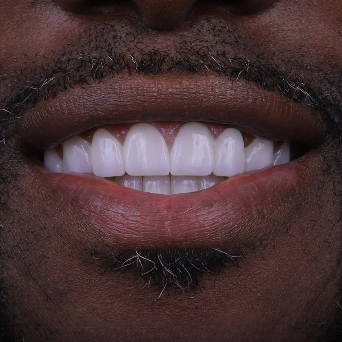 Hollywood Smile result at Dream International Clinic – bright, even teeth after veneers treatment