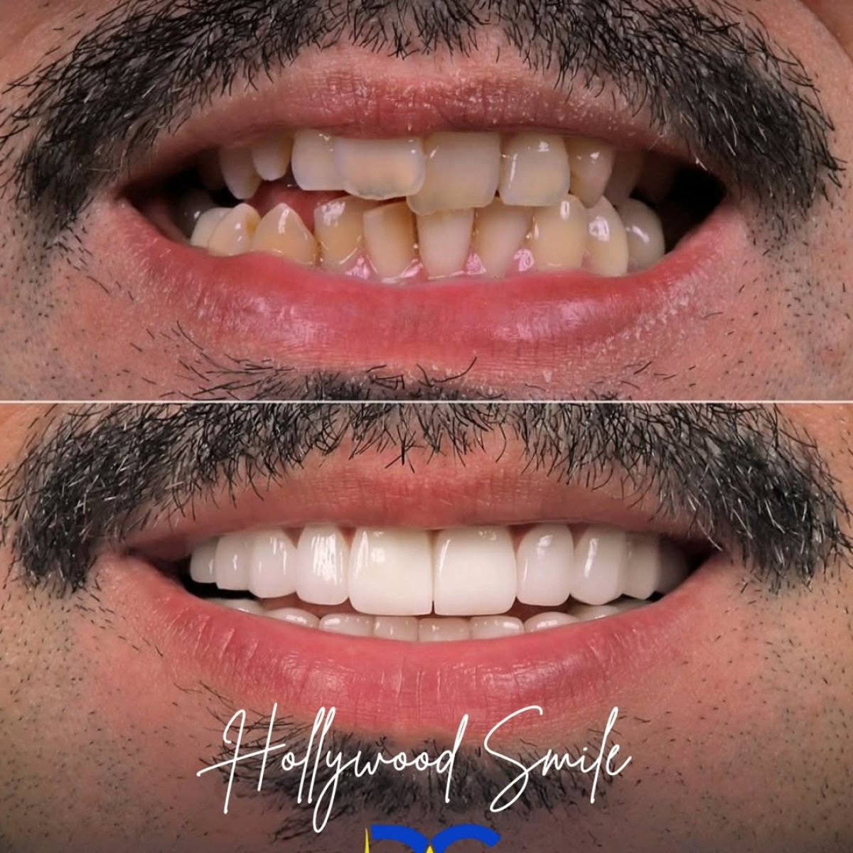 Before and after Hollywood Smile veneers at Dream International Clinic, smile makeover result