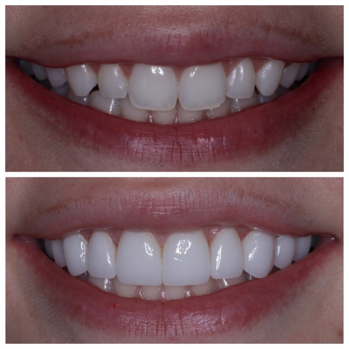 Before and after smile makeover with dental veneers at Dream International Clinic, visible result