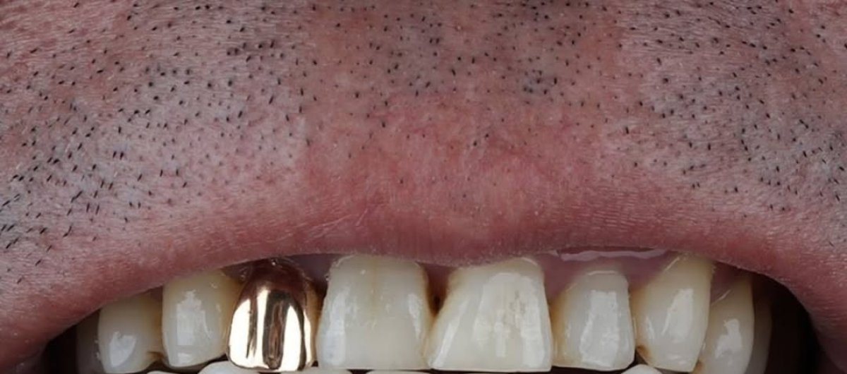 Gold dental crown installation result at Dream International Clinic, upper front tooth restored