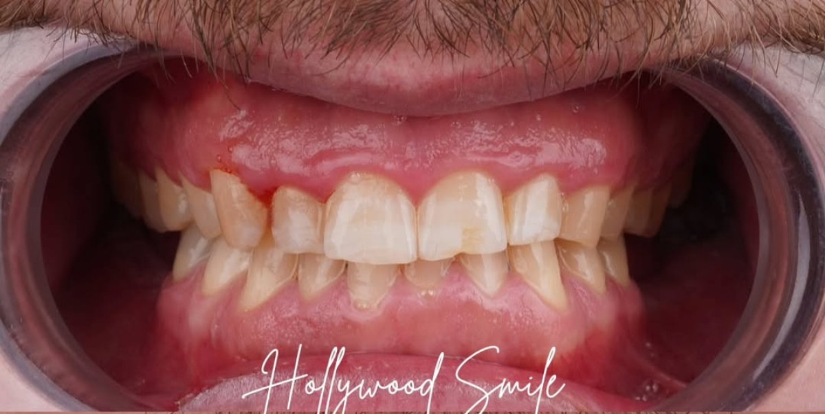 Before dental crown installation at Dream International Clinic – visible tooth imperfections