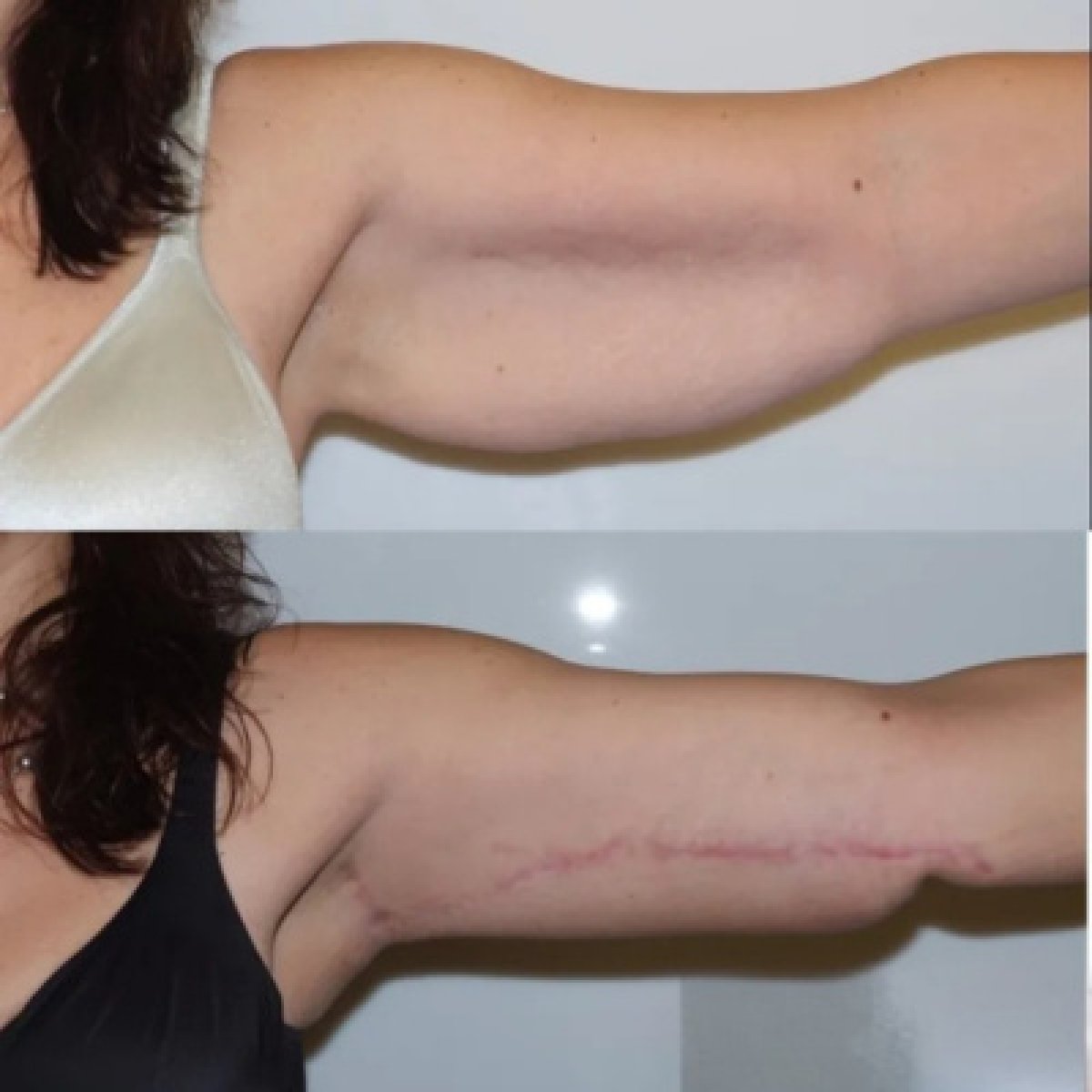 Résultat avant-après lifting des bras (brachioplastie) à Dream International Clinic, contour amélioré