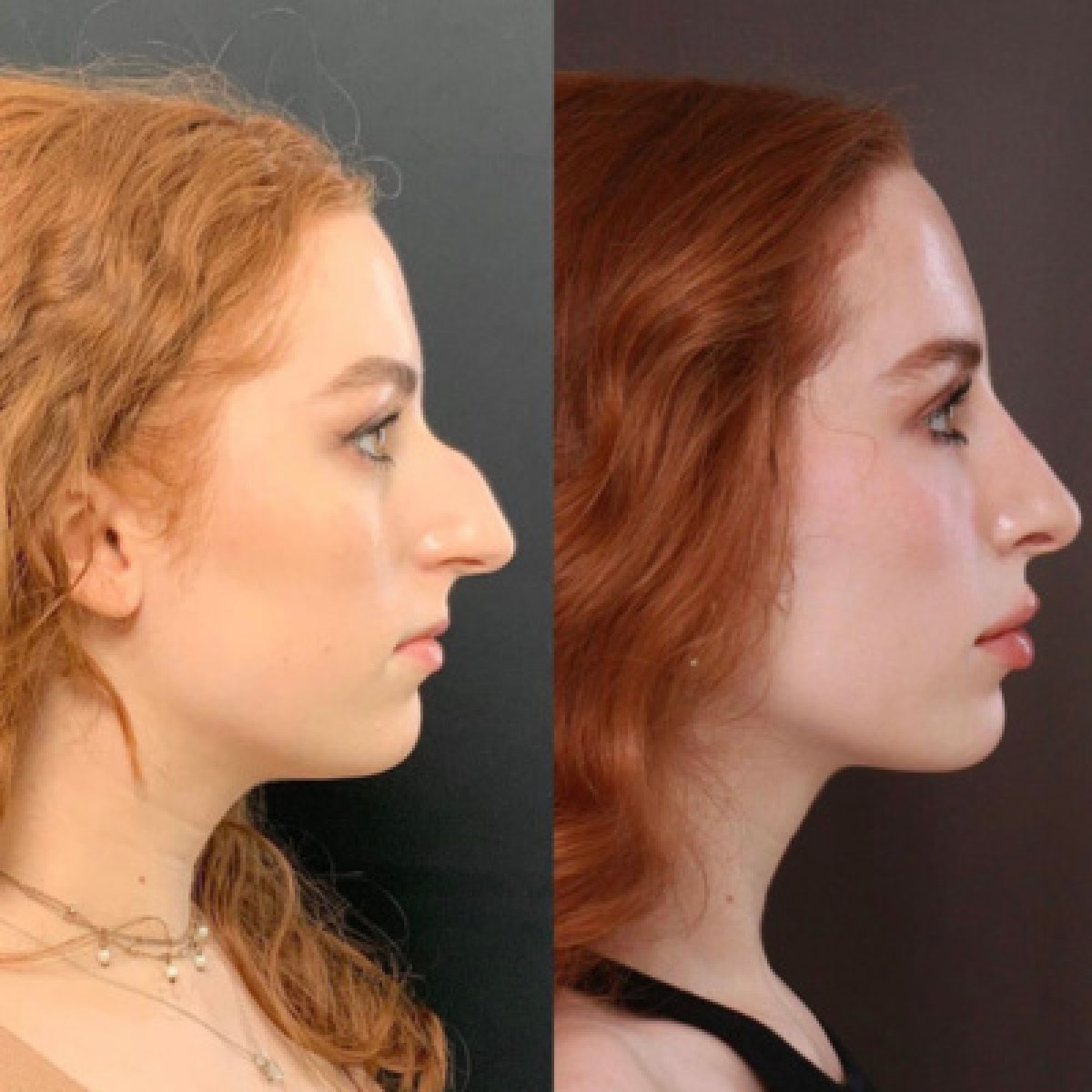 Before and after rhinoplasty result at Dream International Clinic, nose reshaping improvement