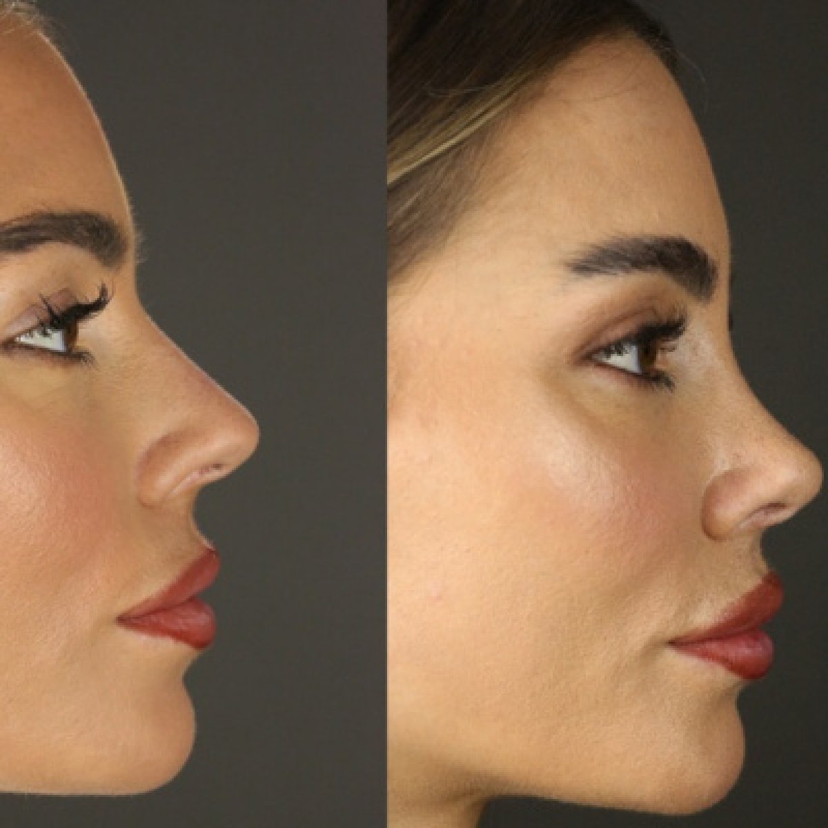 Before and after rhinoplasty results at Dream International Clinic, nose reshaping improvement