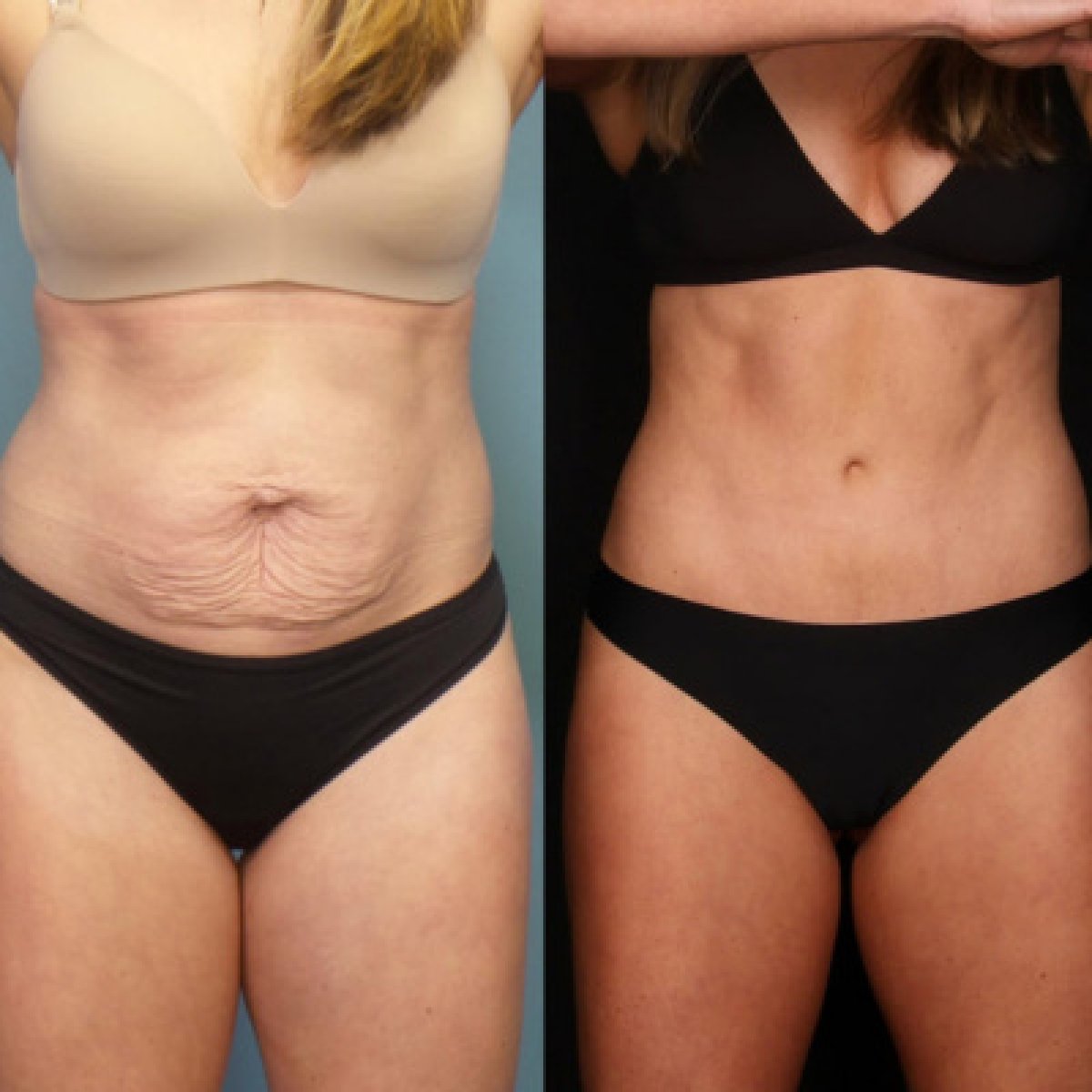 Before and after tummy tuck results at Dream International Clinic, improved abdominal contour