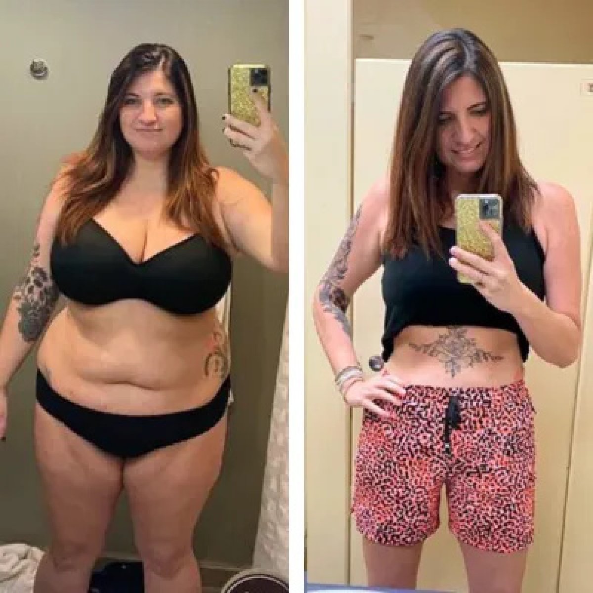 Before and after tummy tuck results at Dream International Clinic, visible body contouring