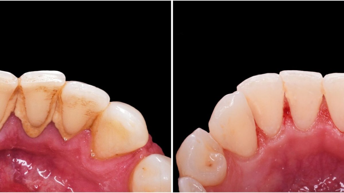 Before and after teeth cleaning (scaling) results at Richter's Clinic – plaque removal