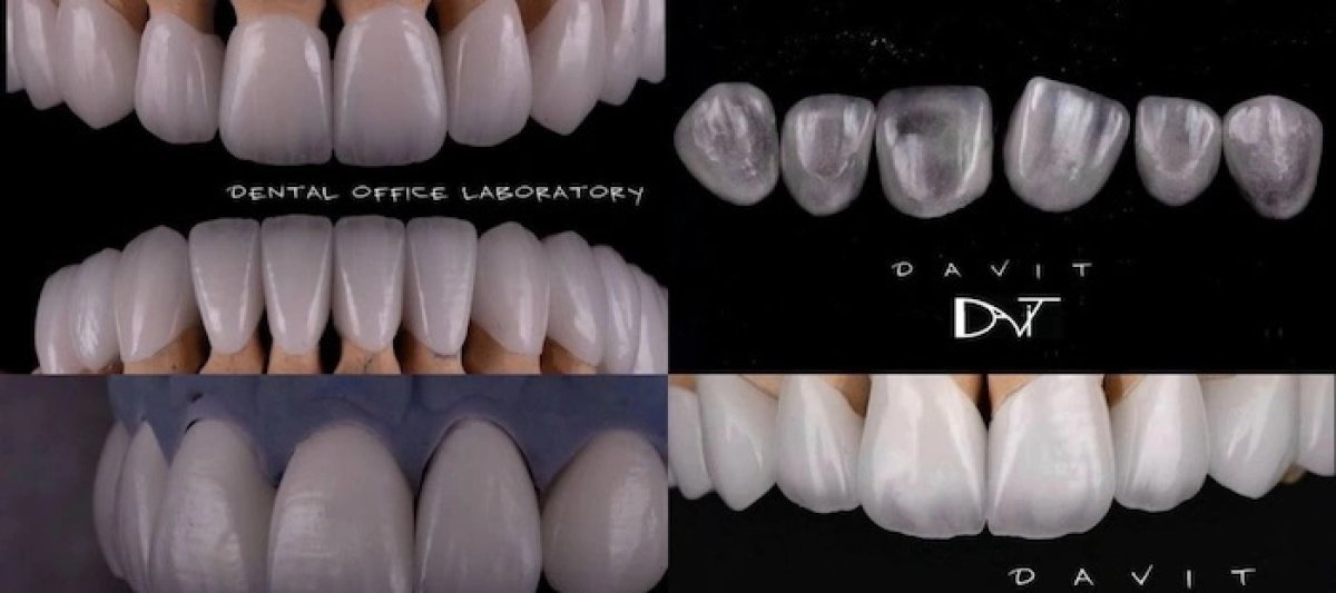 Porcelain veneer before and after results at Richter's Clinic – smile transformation shown