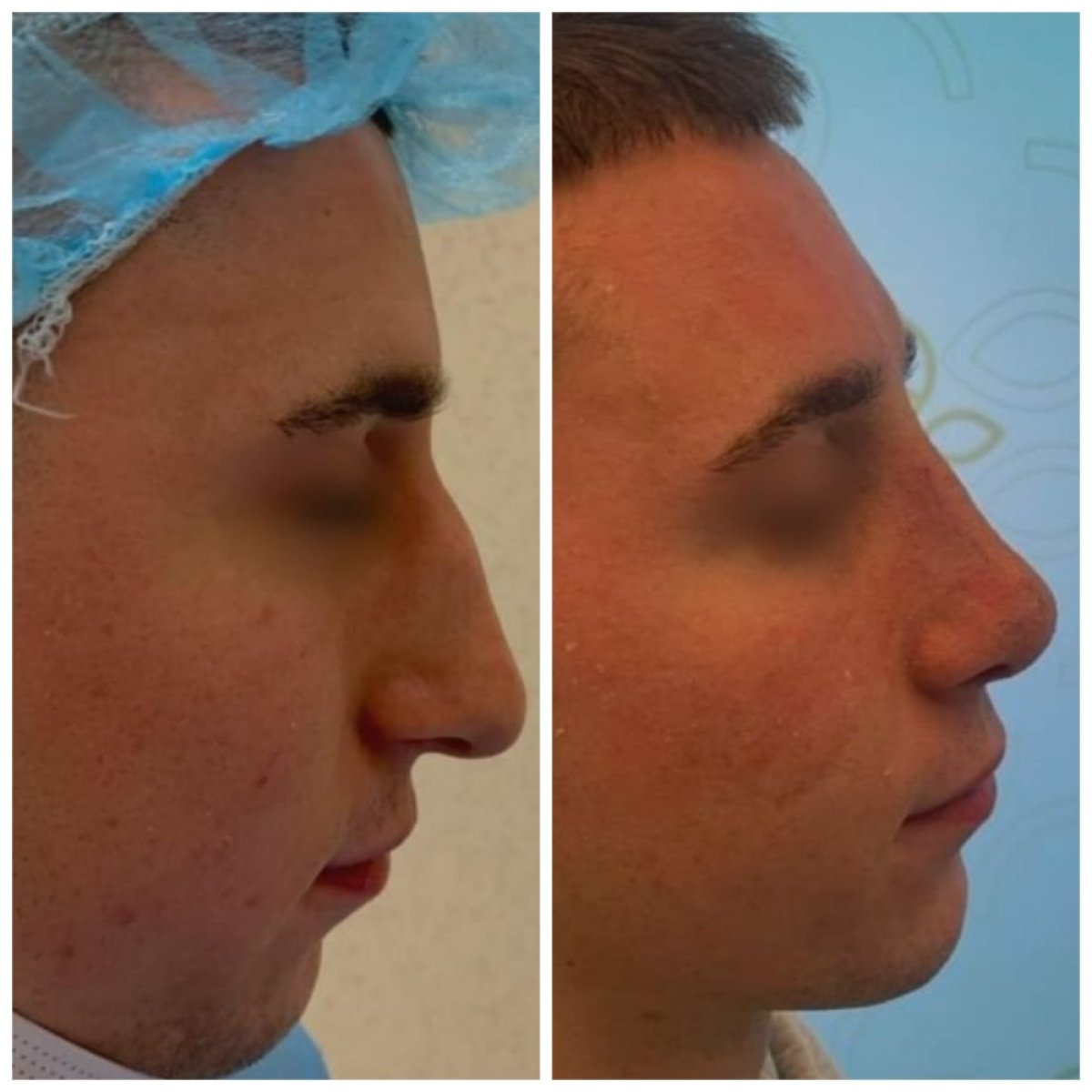 Résultats avant et après rhinoplastie à la Radzikowska Clinic, nez masculin amélioré