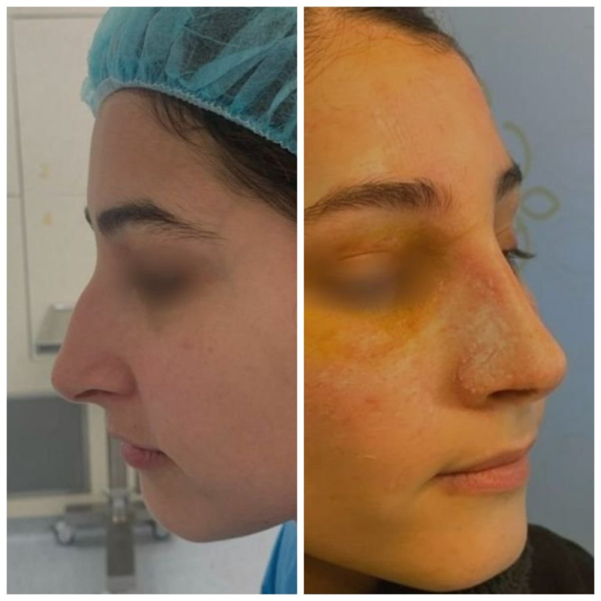 نتائج عملية تجميل الأنف قبل وبعد في عيادة Radzikowska، تحسين شكل الأنف