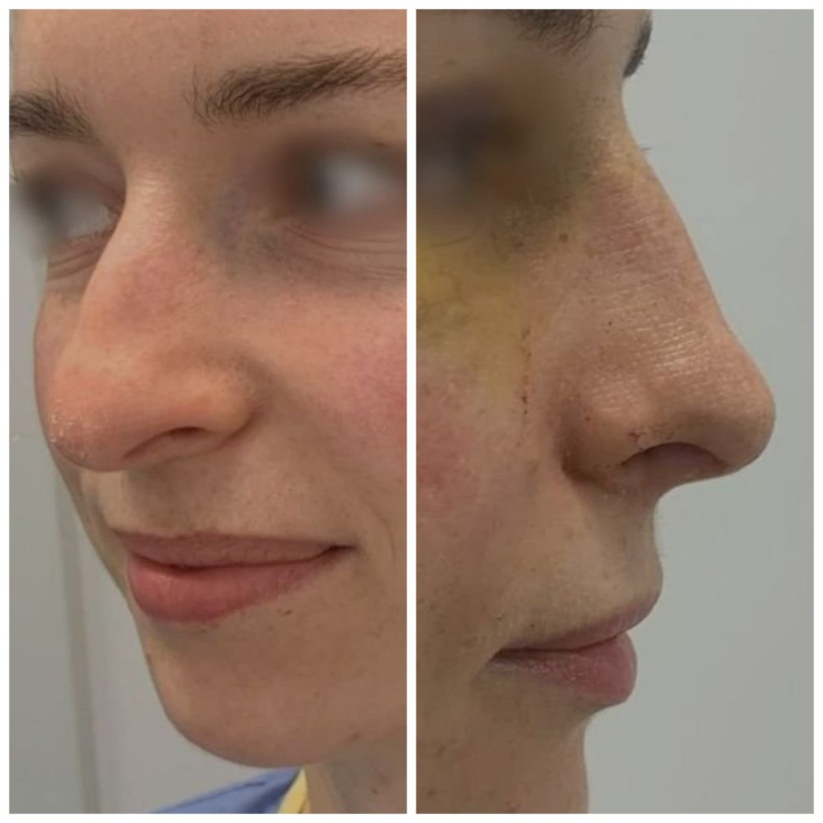 نتائج عملية تجميل الأنف قبل وبعد في عيادة Radzikowska، إعادة تشكيل الأنف بشكل طبيعي
