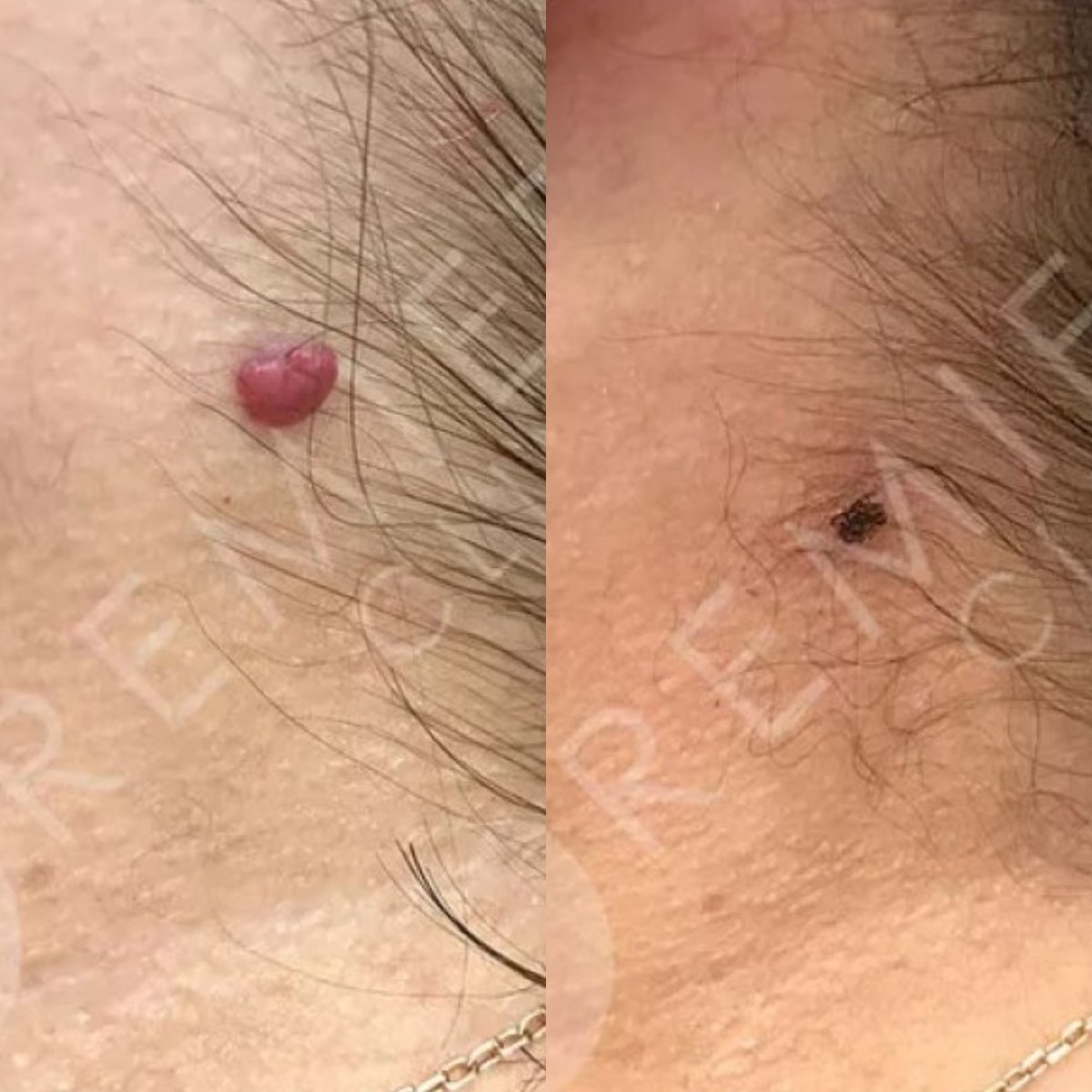 نتائج قبل وبعد إزالة الشامة بالليزر في Premier Clinic، بشرة صافية بعد الإجراء