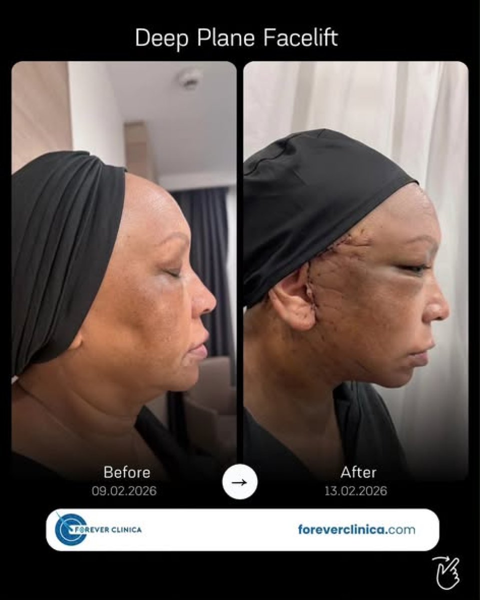 Before and after deep plane facelift results at Forever Clinica, visible facial rejuvenation