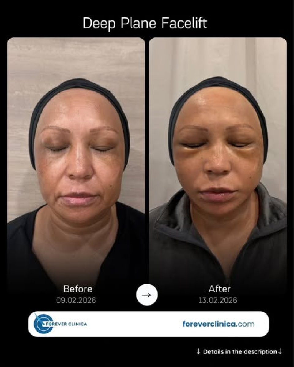 Deep plane facelift before and after results at Forever Clinica, visible facial rejuvenation