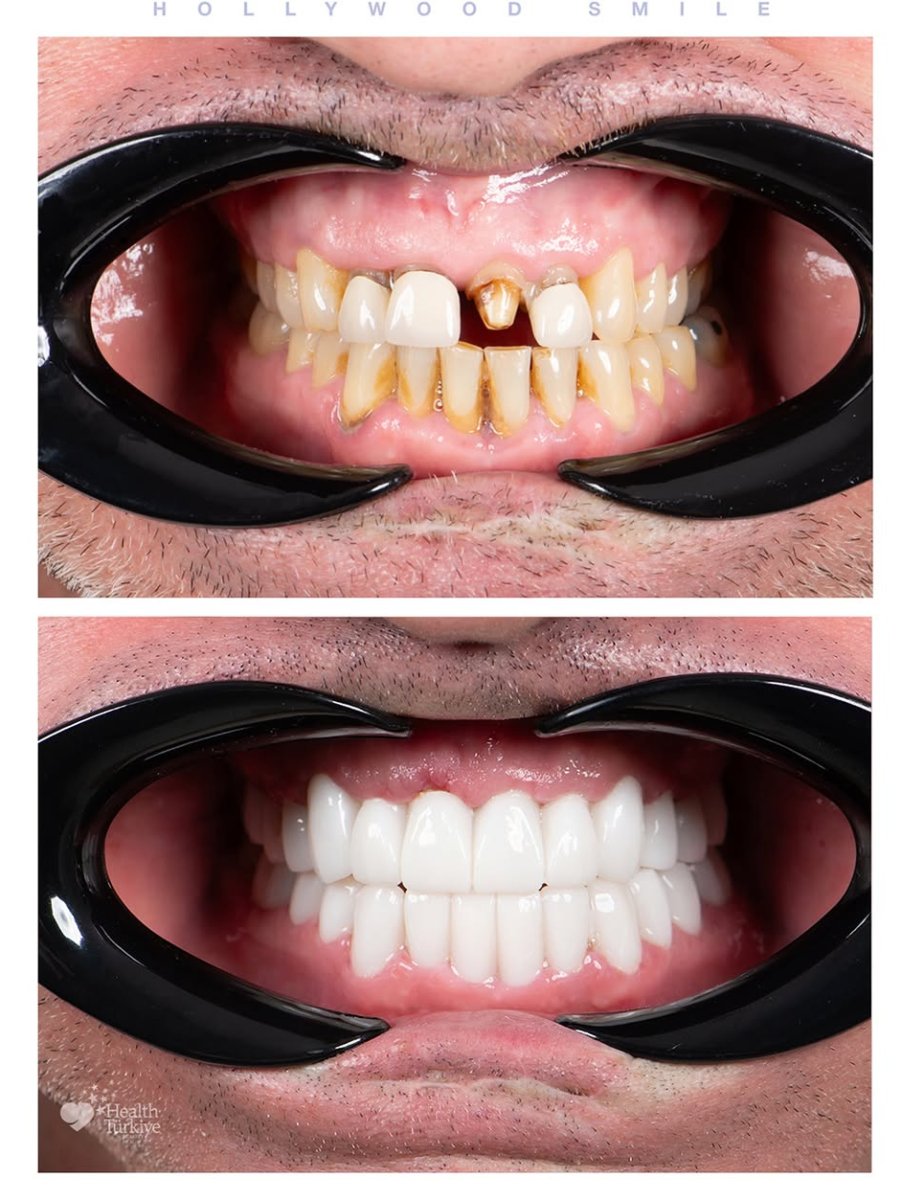 Before and after veneers at Uncali Dental Clinic – Hollywood Smile transformation results