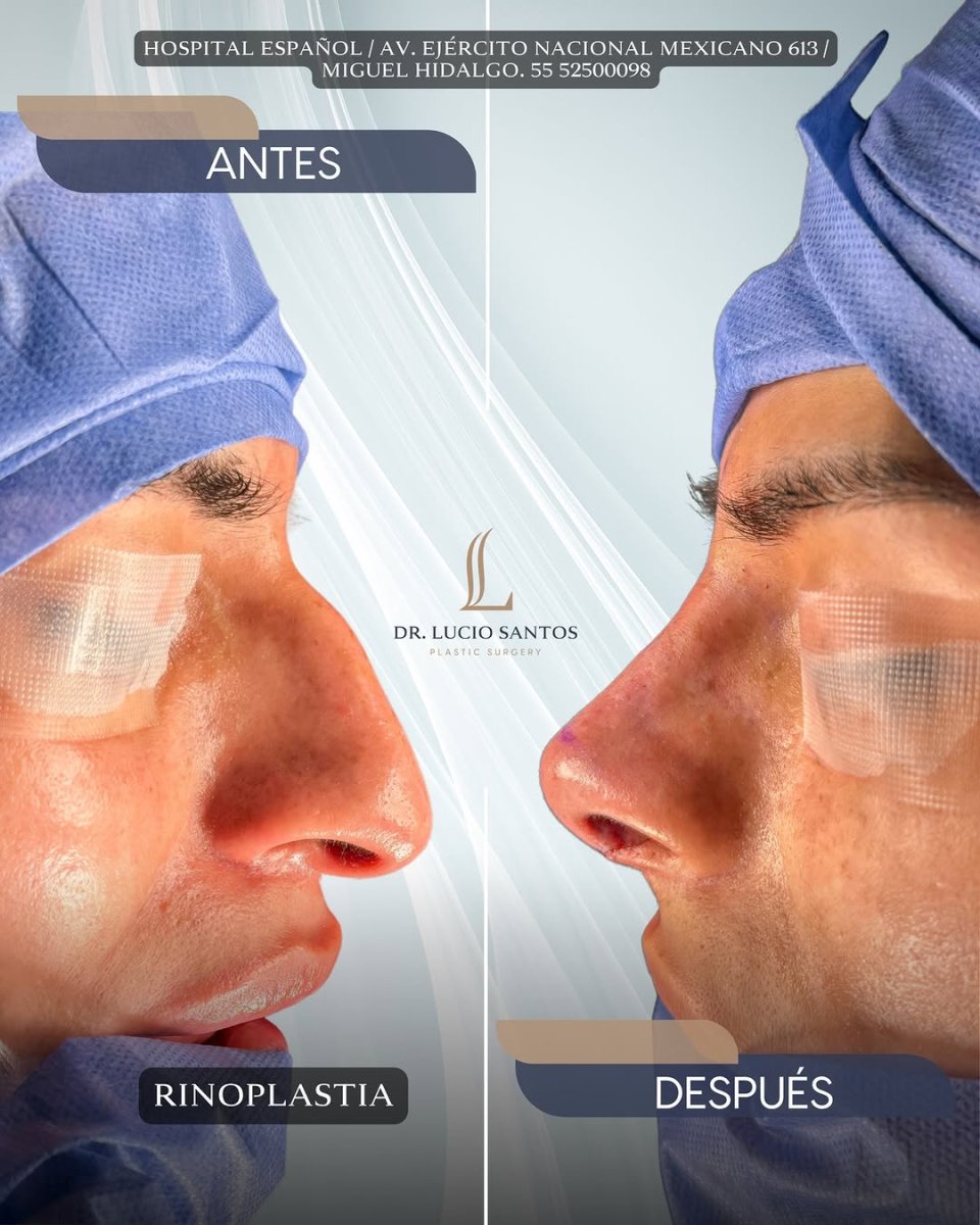 نتائج تجميل الأنف قبل وبعد في Lucio Santos Plastic Surgery، إعادة تشكيل الأنف