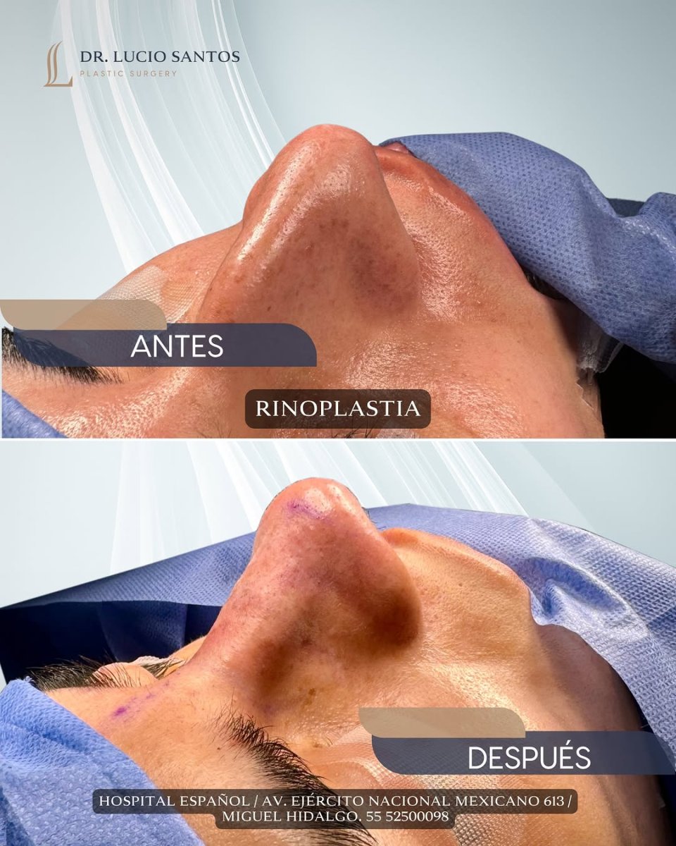 Résultat avant et après rhinoplastie chez Lucio Santos Plastic Surgery, forme du nez améliorée