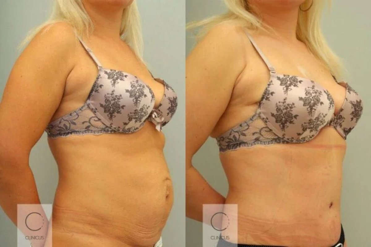 Resultados de abdominoplastia antes y después en Clinicus Klaipeda – abdomen más plano