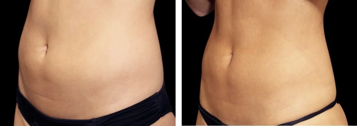 Resultados de abdominoplastia antes y después en Clinicus Klaipeda – abdomen más plano