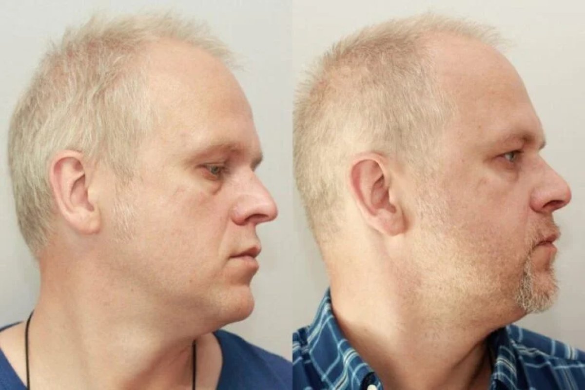 نتائج شد الرقبة قبل وبعد في Clinicus Klaipeda، تحديد أفضل للفك