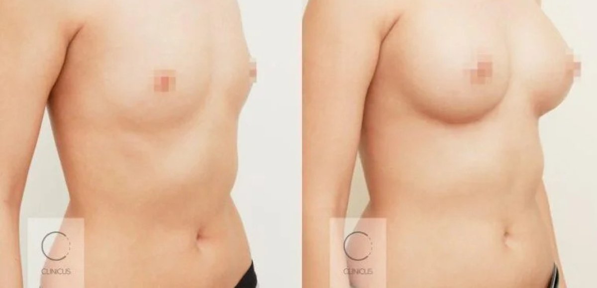 Antes y después de aumento de senos con implantes anatómicos en Clinicus Klaipeda, resultado visible