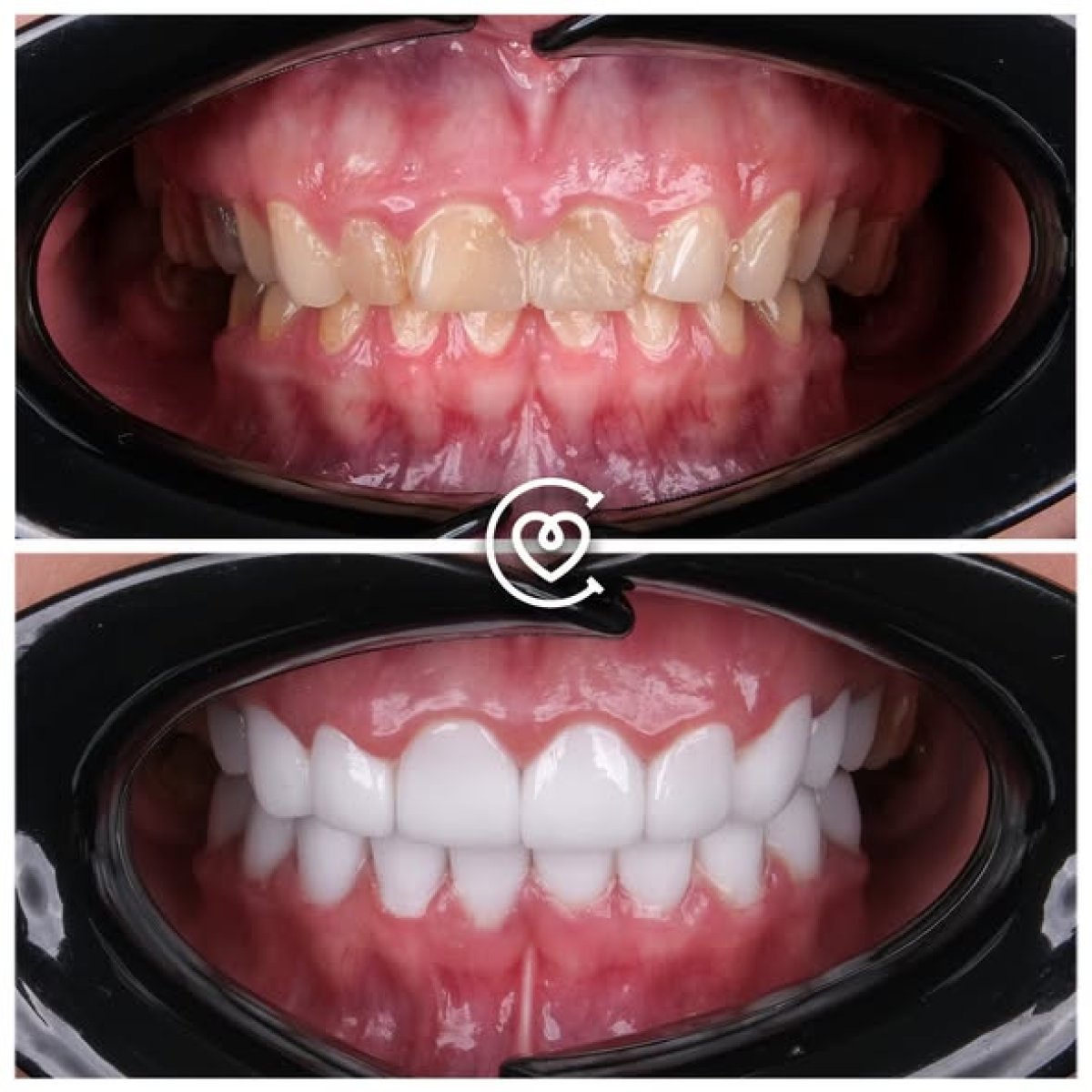 Vorher-nachher-Veneers bei Cayra clinic – Smile-Transformation mit weißen, geraden Zähnen