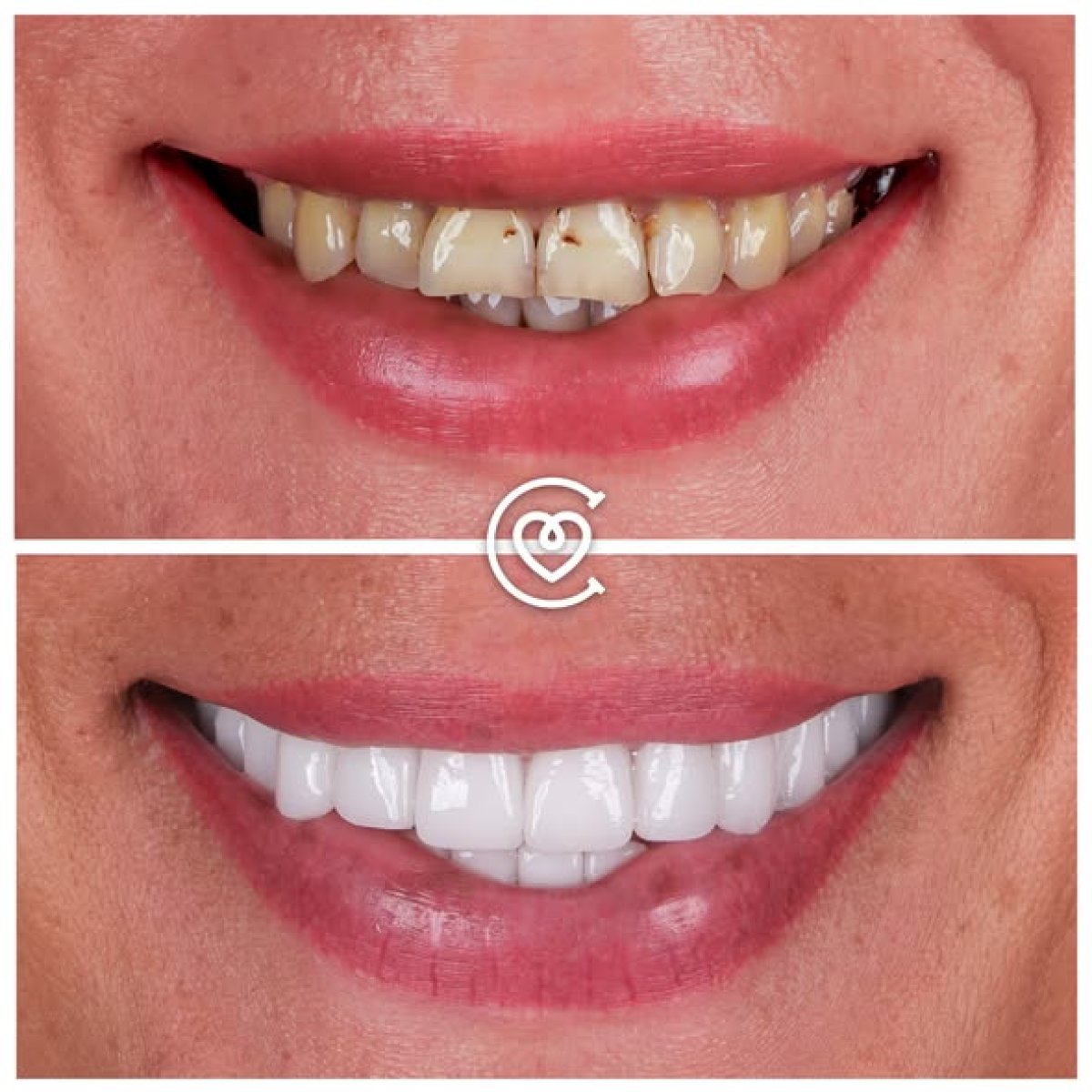 Before and after veneers at Cayra clinic – smile makeover with natural white teeth result
