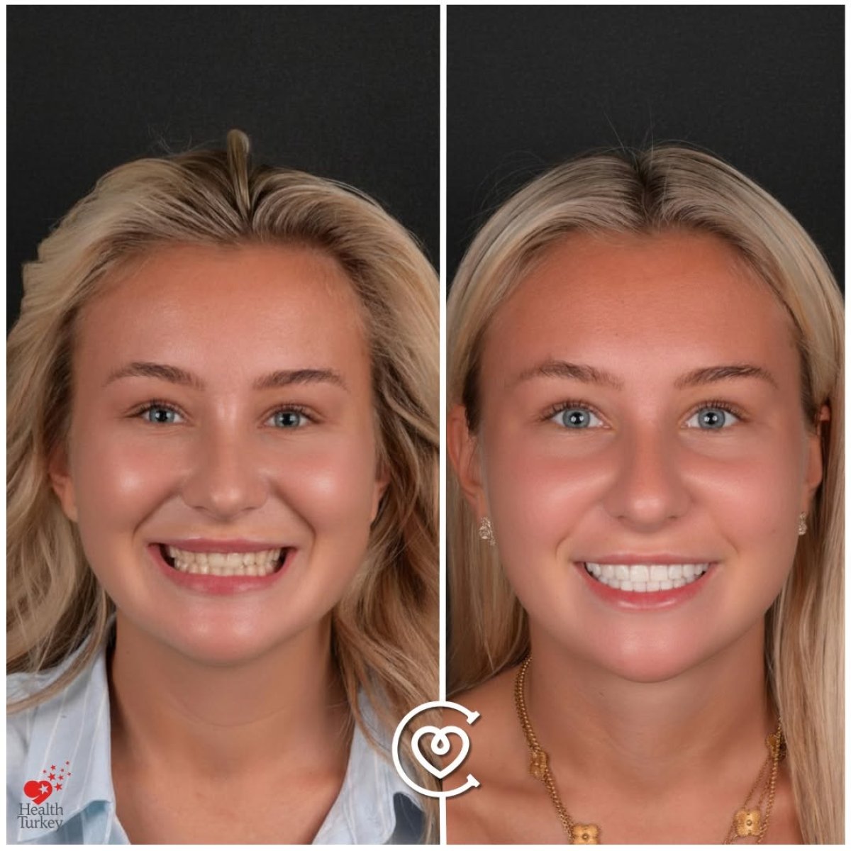 Resultados antes y después de carillas de composite en Cayra clinic – sonrisa mejorada