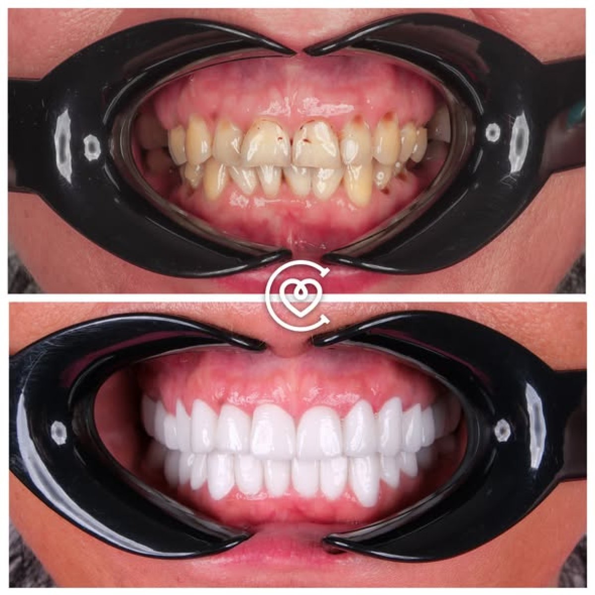 Before and after smile makeover at Cayra clinic – dental veneers for whiter, even teeth result