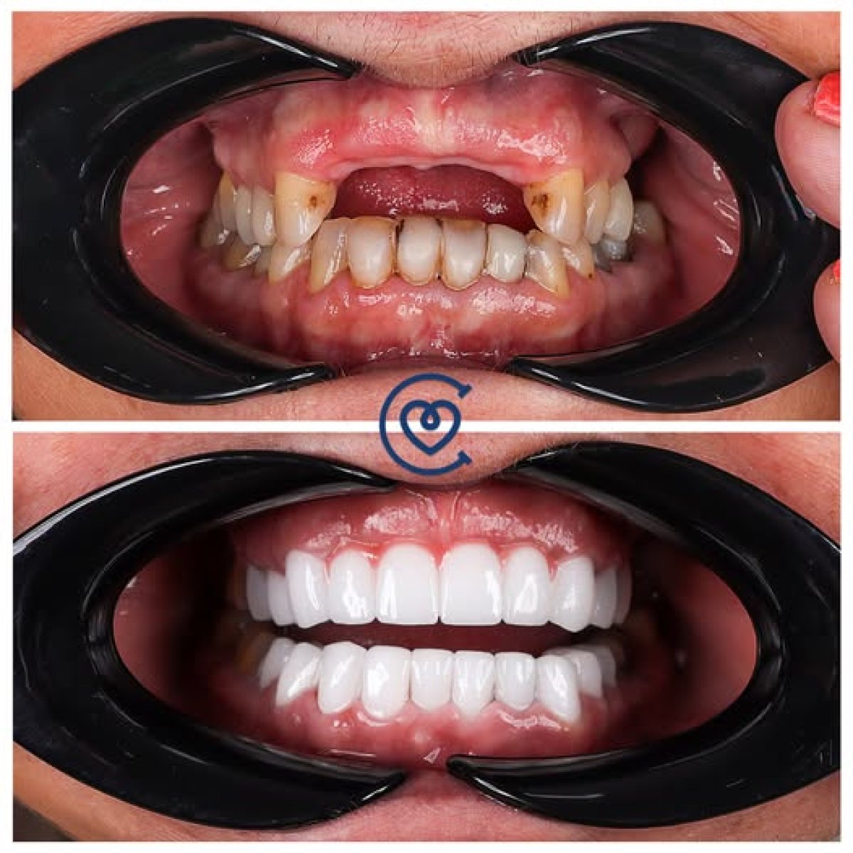 Smile Makeover Vorher-Nachher-Ergebnis bei Cayra clinic – komplette Zahnsanierung