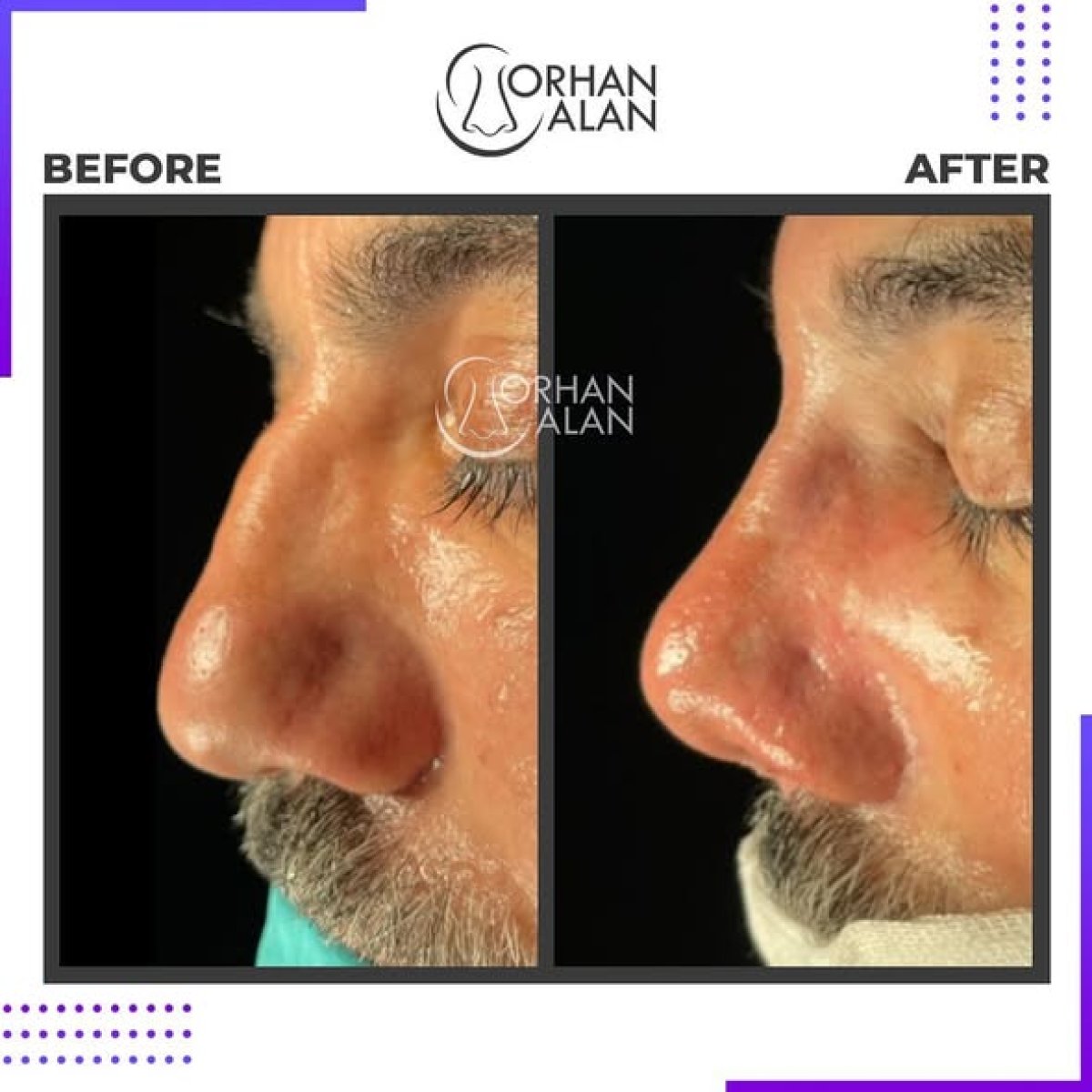 Before and after rhinoplasty results at Dr.Orhan ALAN Clinic, improved nose shape and contour
