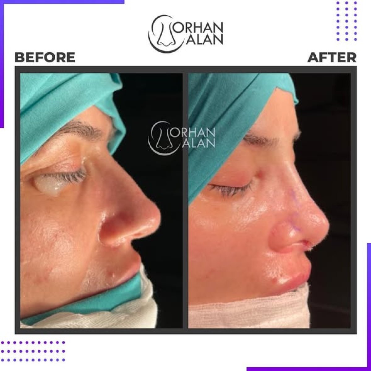 Before and after rhinoplasty results at Dr.Orhan ALAN Clinic, improved nose profile