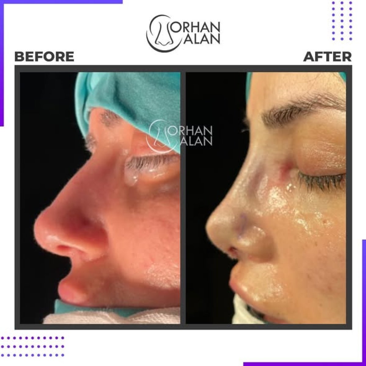 Resultados de rinoplastia antes y después en Dr.Orhan ALAN Clinic, perfil nasal mejorado