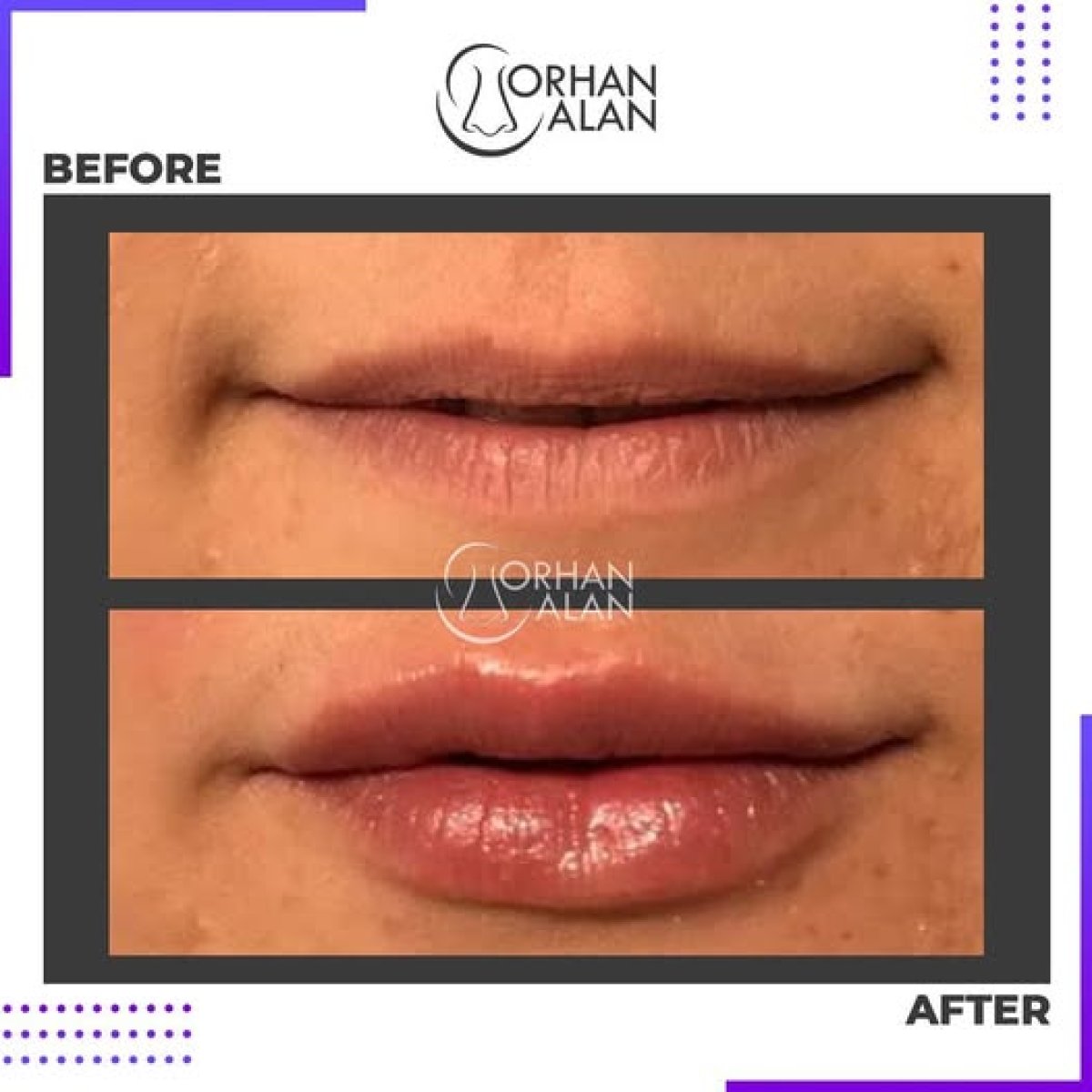 Before and after lip fillers injection at Dr.Orhan ALAN Clinic, enhanced lip volume result