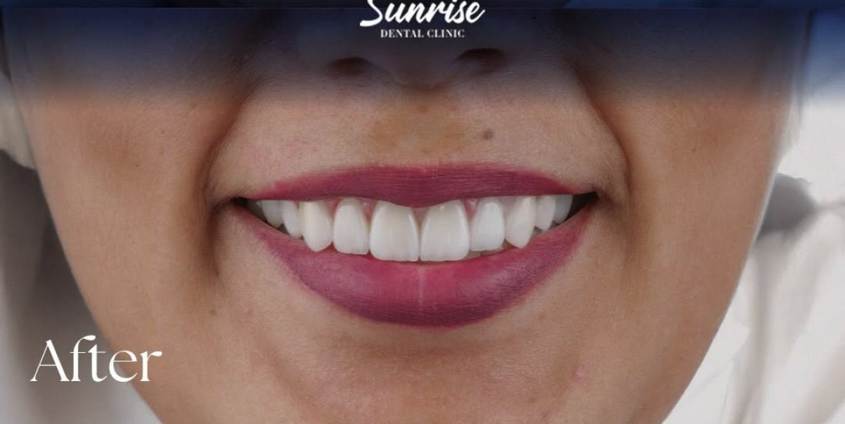 Resultado de blanqueamiento dental en Sunrise Dental Clinic: sonrisa más blanca y brillante