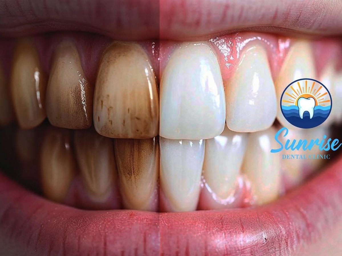 Resultados de blanqueamiento dental antes y después en Sunrise Dental Clinic – sonrisa más blanca