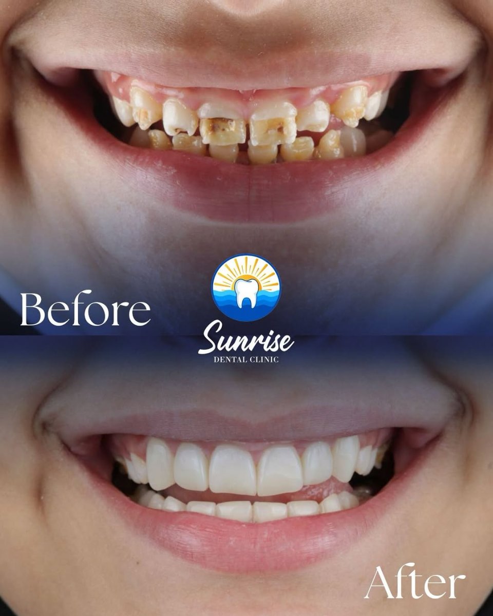 Efekt przed i po licówkach Emax w Sunrise Dental Clinic – widoczna metamorfoza uśmiechu
