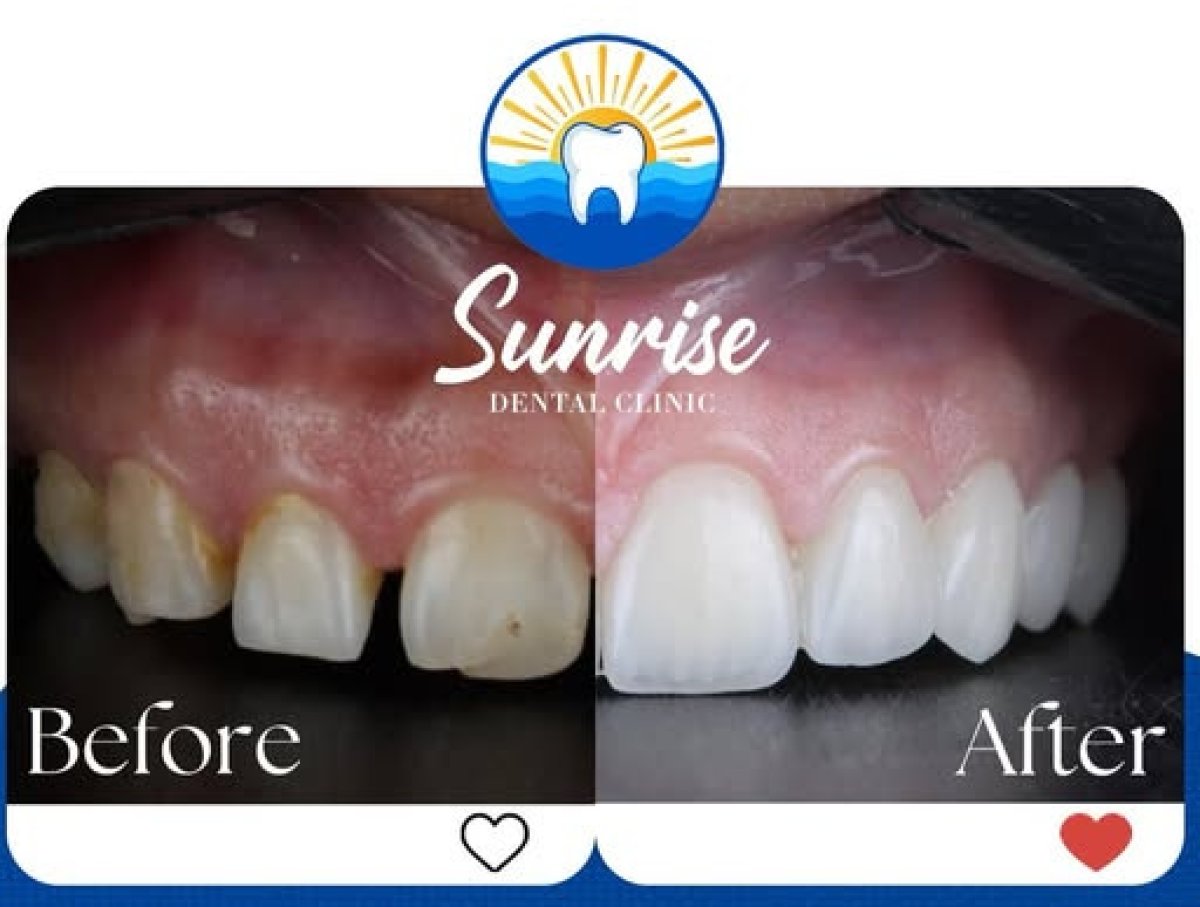 نتيجة قبل وبعد الفينير في Sunrise Dental Clinic – ابتسامة محسنة وأسنان أكثر بياضًا